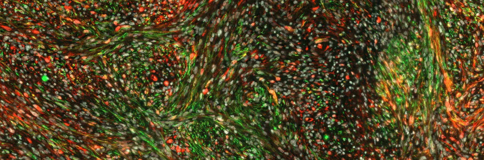 Schwannoma